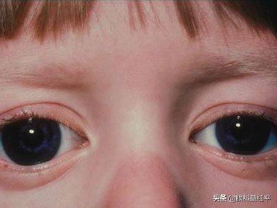 青光眼的症状（形形色色的青光眼） 第1张