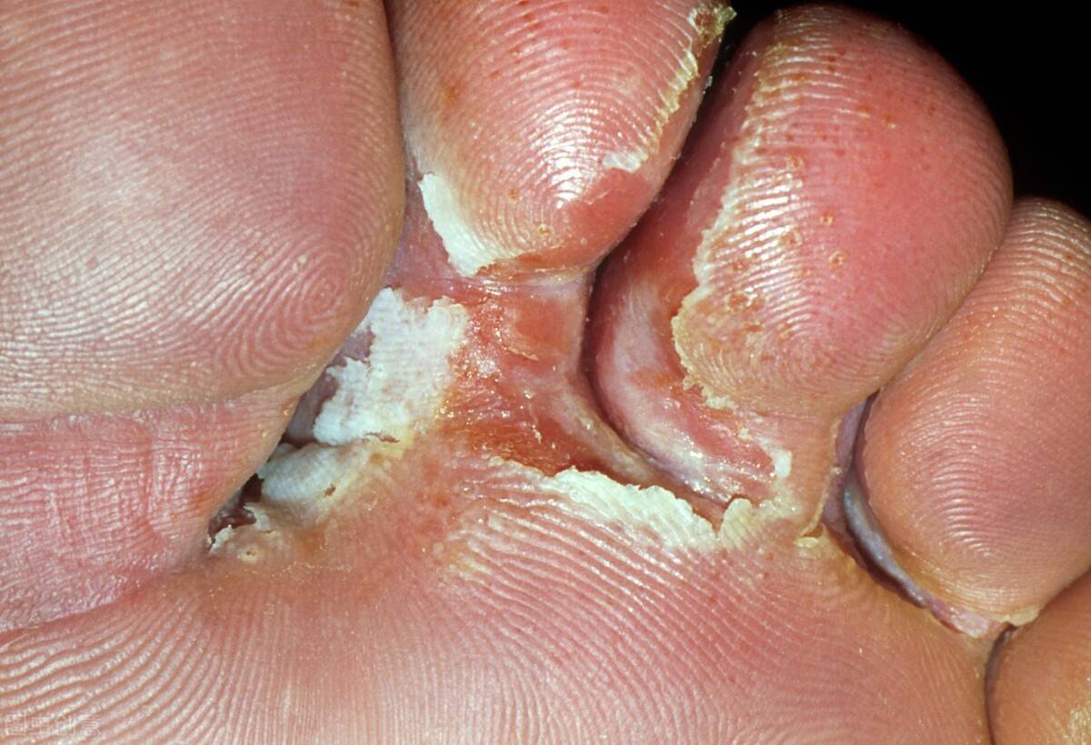 水泡脚气（脚上起红疹水泡，到底是脚气还是湿疹？） 第1张