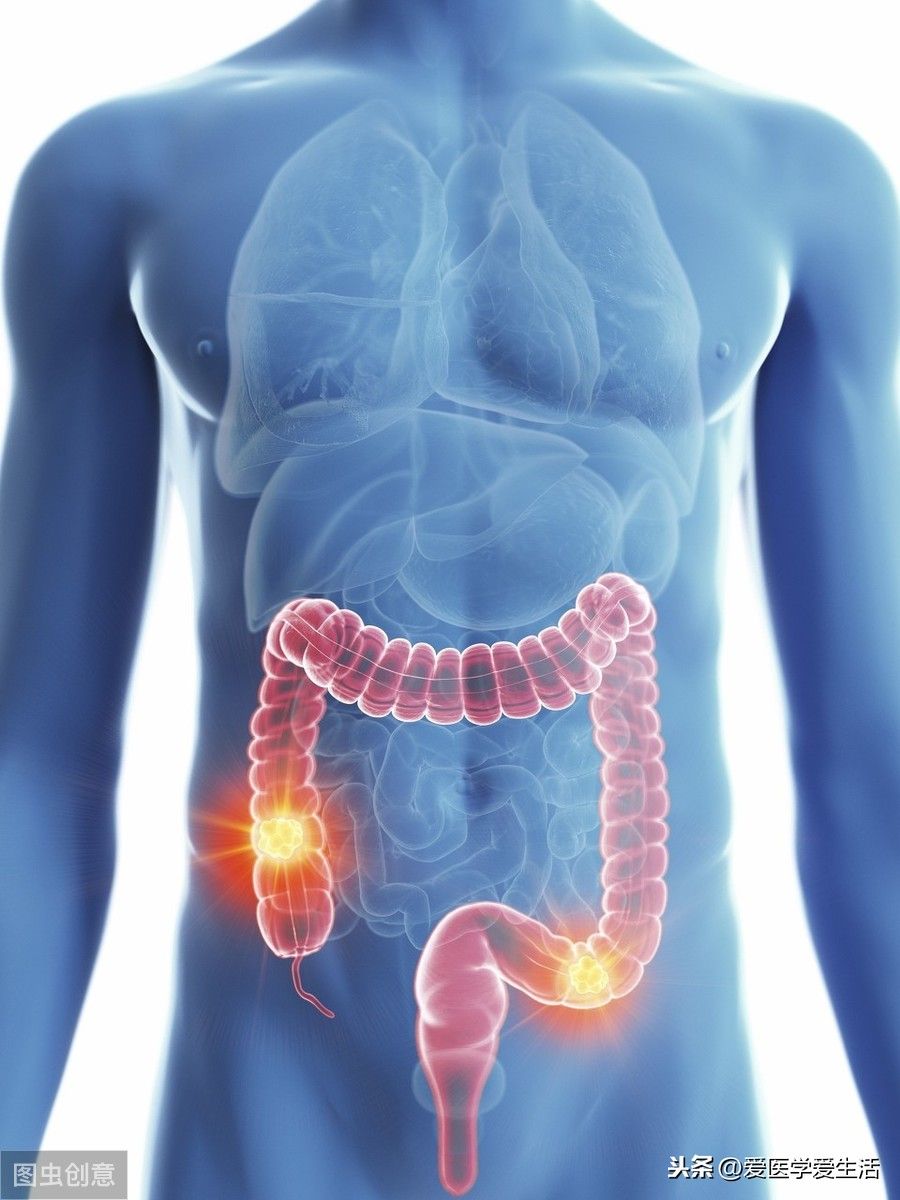 胃肠道间质肿瘤（胃肠道间质瘤的病源、确诊） 第1张