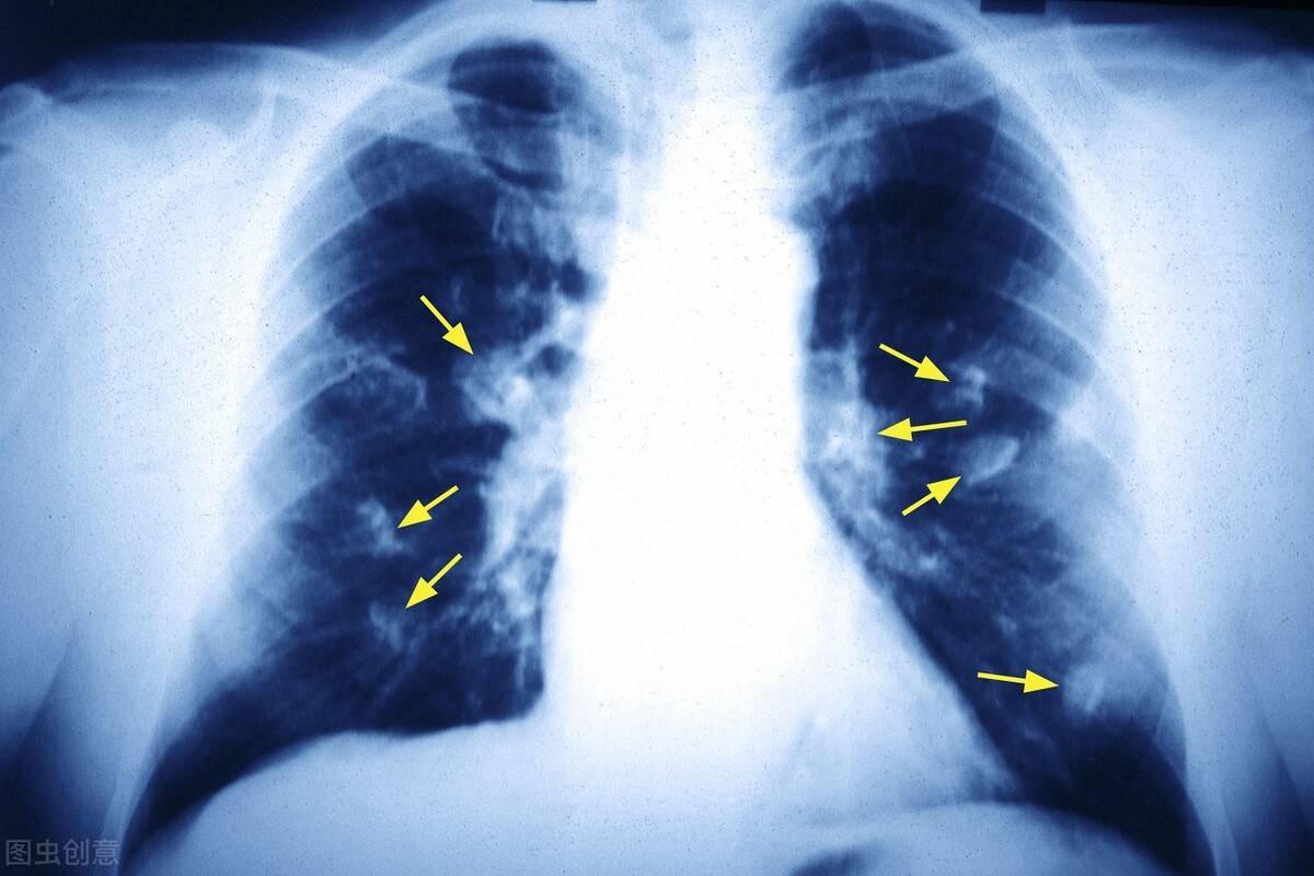 肺癌晚期能活多久（晚期肺癌有没有“征兆”？还能活多久？） 第2张