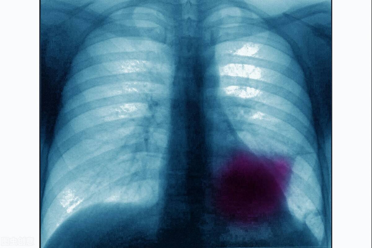 肺癌晚期能活多久（晚期肺癌有没有“征兆”？还能活多久？） 第1张
