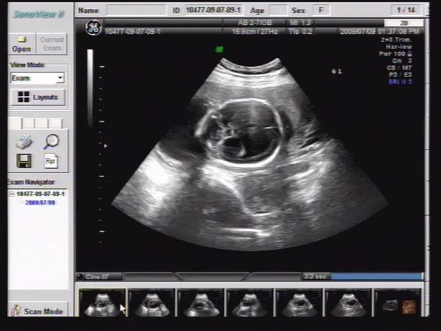 胎儿脑积水几个月可以检查出来，胎儿脑积水几周可以查出 第2张